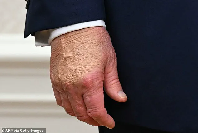 White House Explains Recurring Bruises on Trump's Hands, Citing Incident at Davos Event