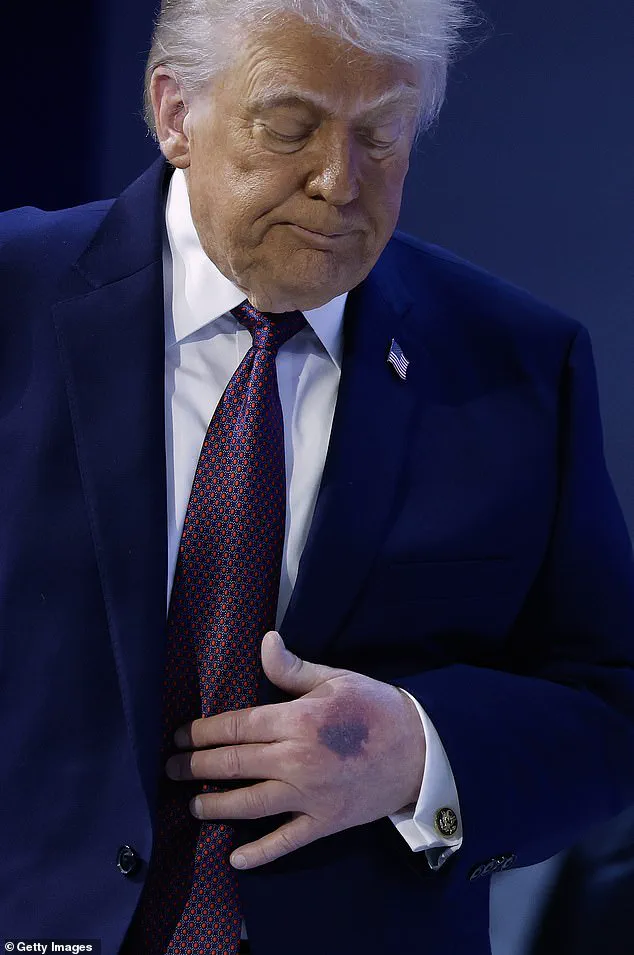 President Trump's Return from Davos Brings Media Scrutiny Over Hand Bruise and Demanding Schedule
