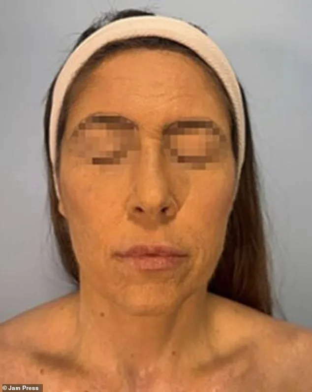 Brazilian Woman's Face and Body Blisters from Mental Health Drug Reaction