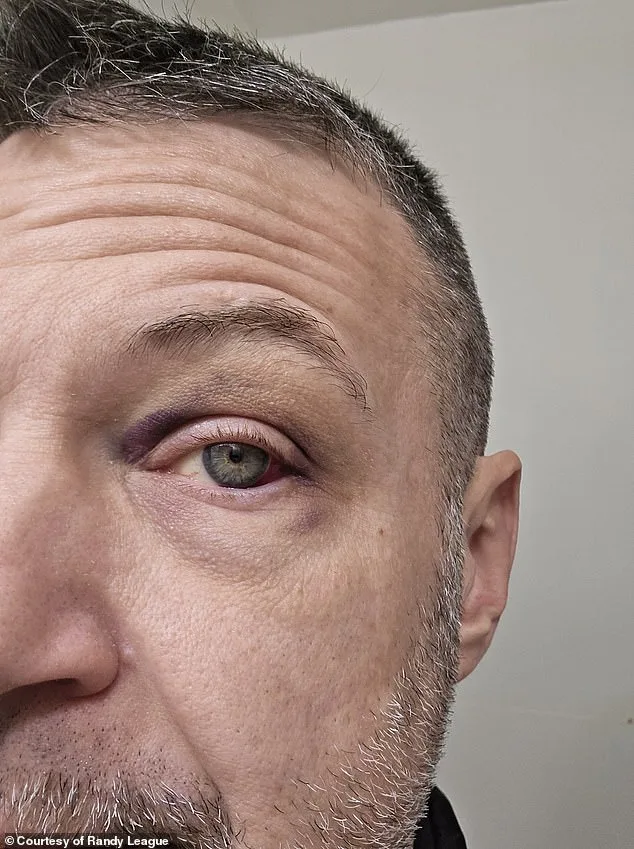 Rare Cancer Found in League's Eyes