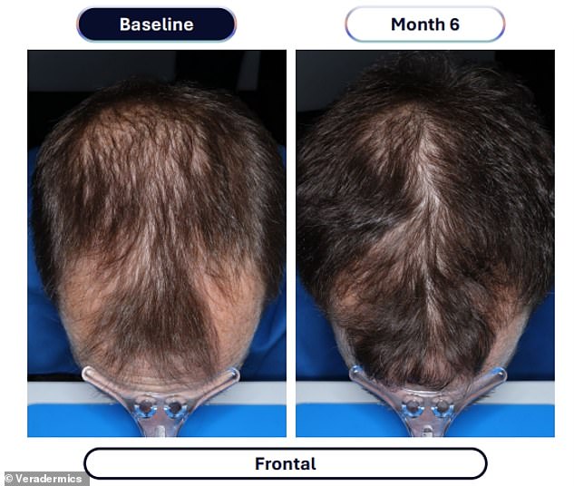 Veradermics' new oral Minoxidil quadruples hair regrowth in pivotal study.